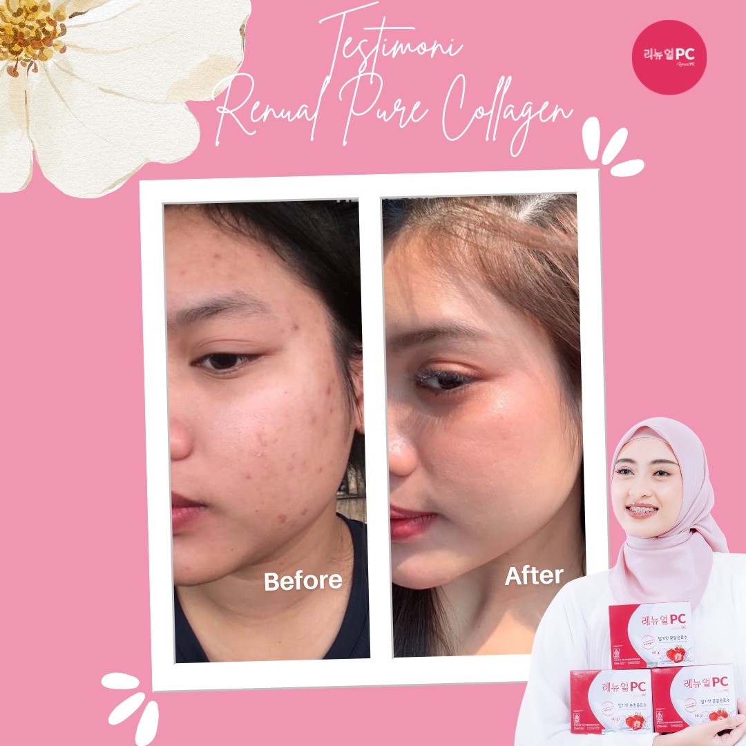 Kartu resmi before after: bekas jerawat mereda