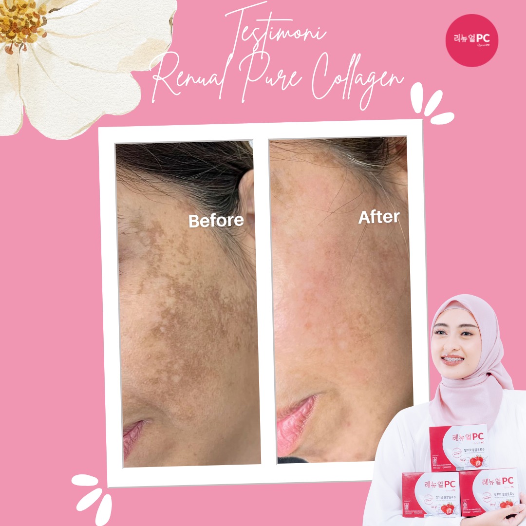 Kartu resmi before after: flek hitam memudar